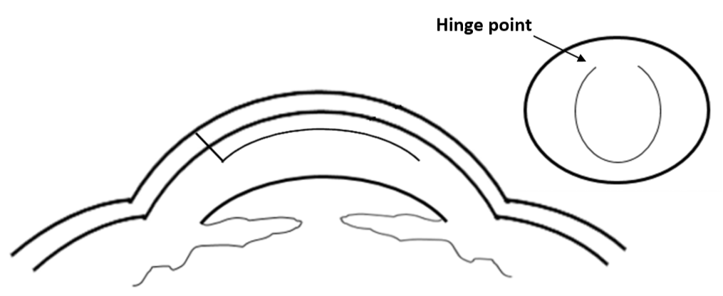 Cornea cross section indicating the hinge point for LASIK surgery. 
