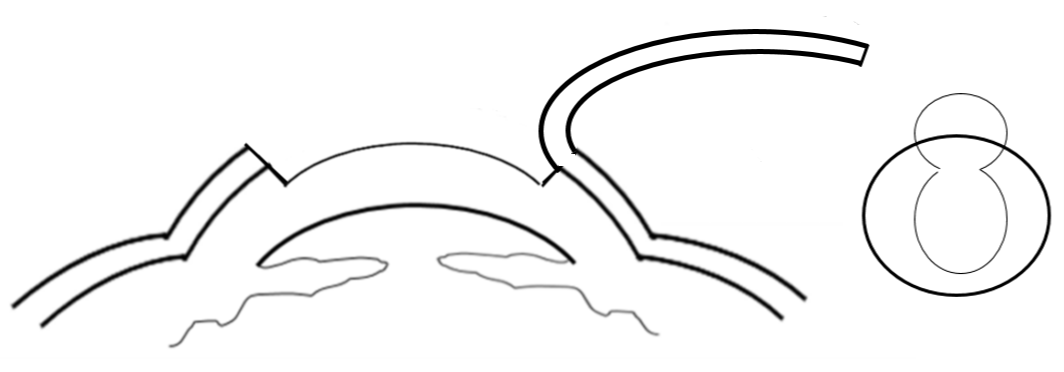 Cornea cross section indicating where the flap opens in LASIK surgery. 