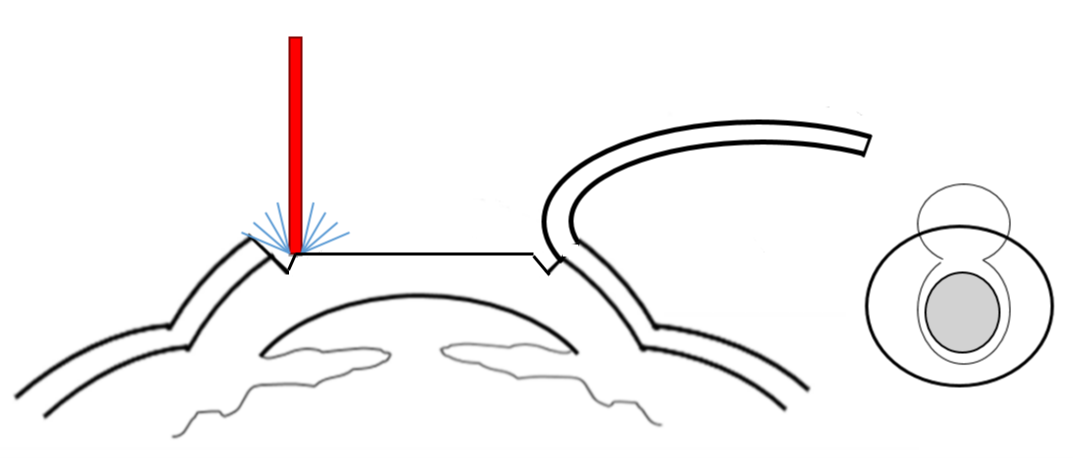 Cornea cross section indicating where the laser reshapes the cornea in LASIK surgery. 