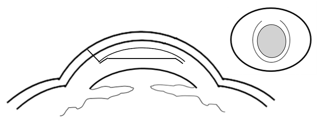 Cornea cross section indicating where the flap is re positioned and smoothed out. 