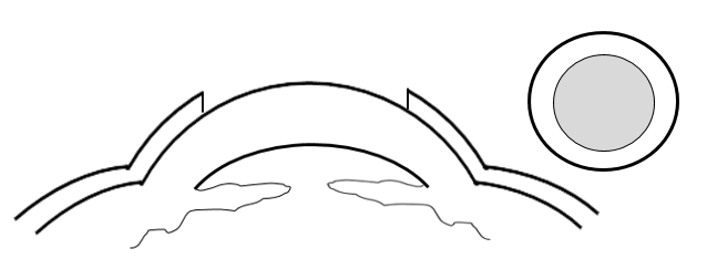 Cross section view of the cornea, with the epithelium removed with a circular brush to indicate the first step in PRK surgery. 