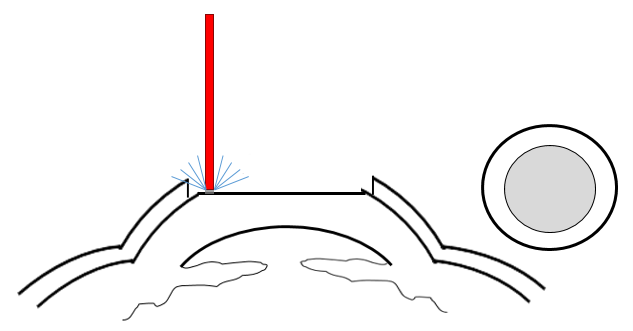 Cross section of the cornea indicating the second step of PRK is that the laser removes tissue to reshape the eye. 