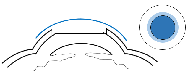 Cross section of the cornea indicating PRK post - operation. A bandage contact lens is placed on the eye. 