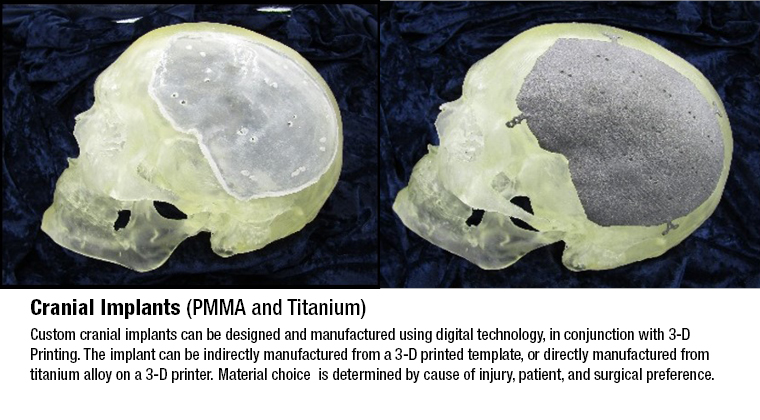 Photo of 3D MAC Cranial Implant